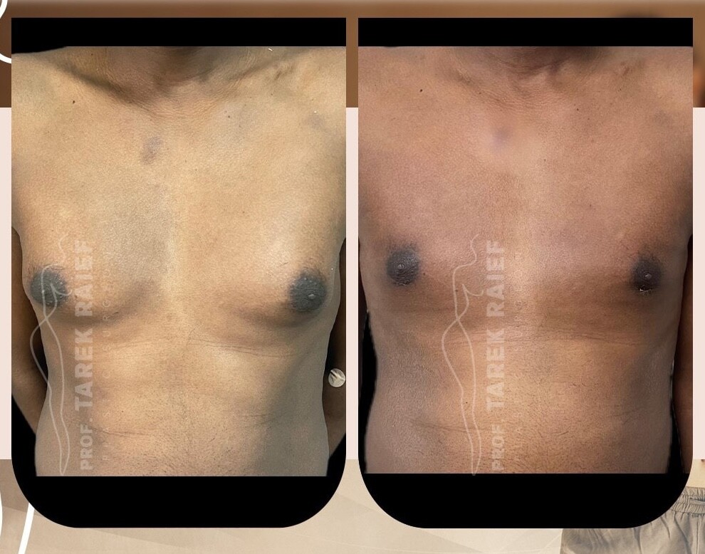 Before and After Result